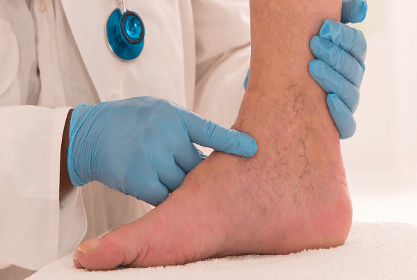 RFA or Venaseal Minimally Invasive Surgery for Varicose Veins