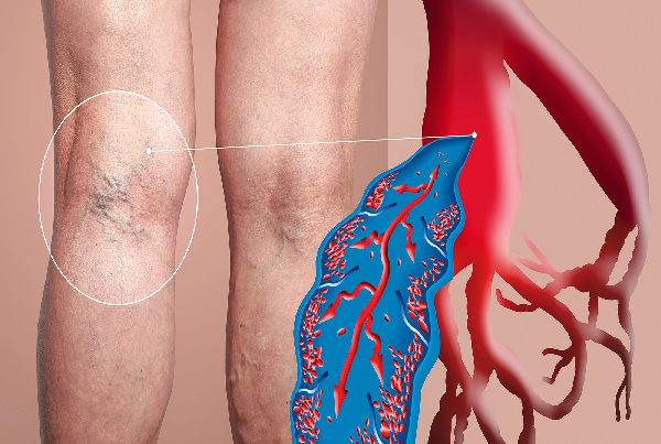 DVT Filter Treatment