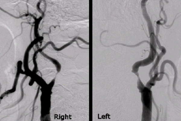 Carotid Stenosis