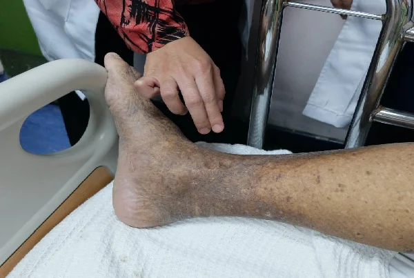 Blockage of Leg Arteries
