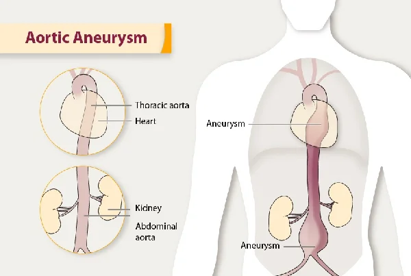 Aortic Aneurysm