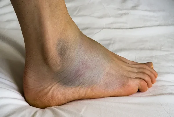 Swelling Leg Treatment