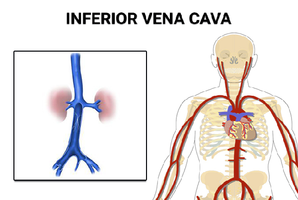 IVC Filter Placement