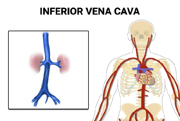 IVC Filter Placement
