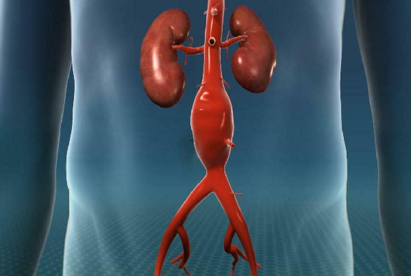 Aorto Iliac & Femoral Angioplasty